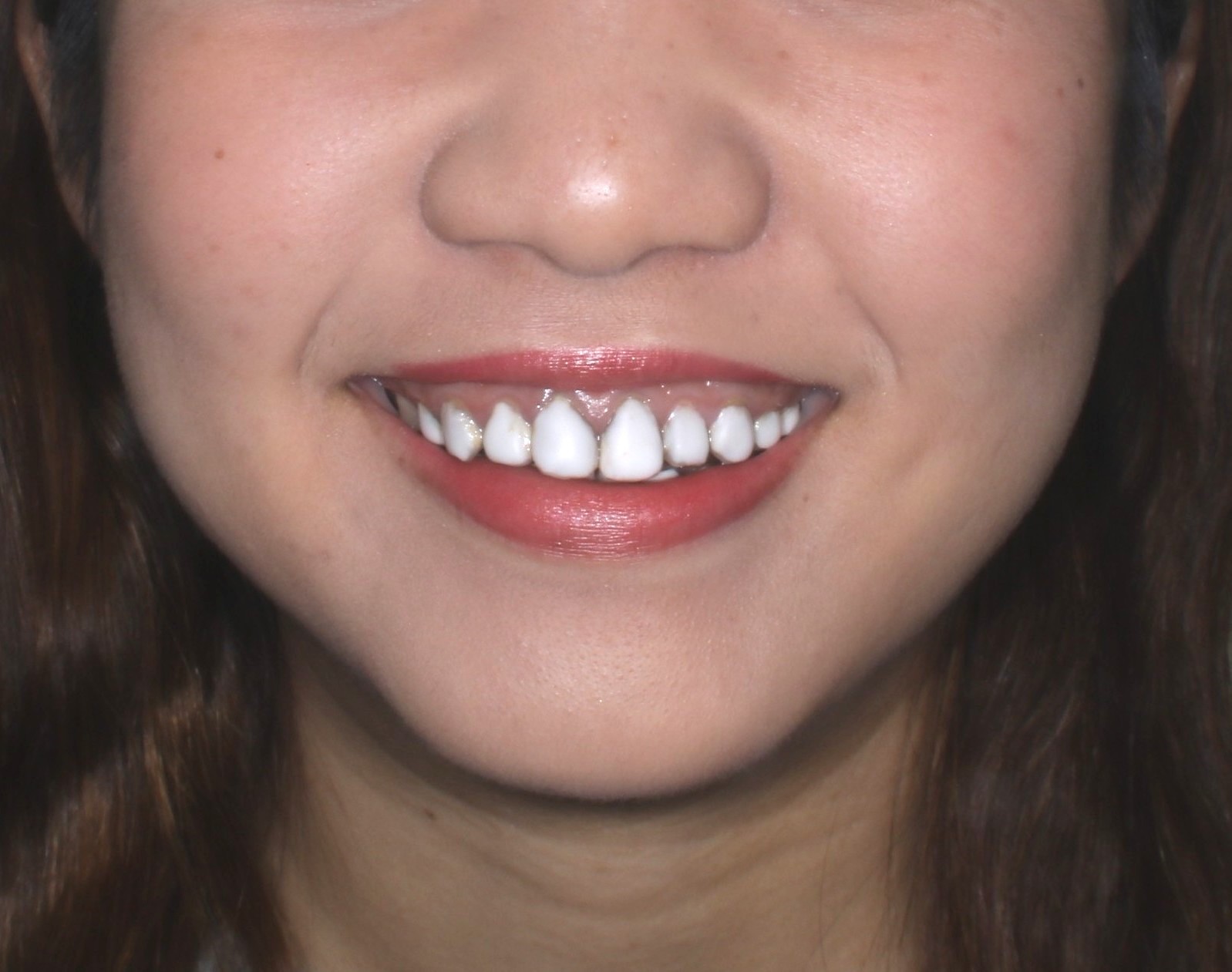 前歯をセラミッククラウンとラミネートベニアで治療した症例