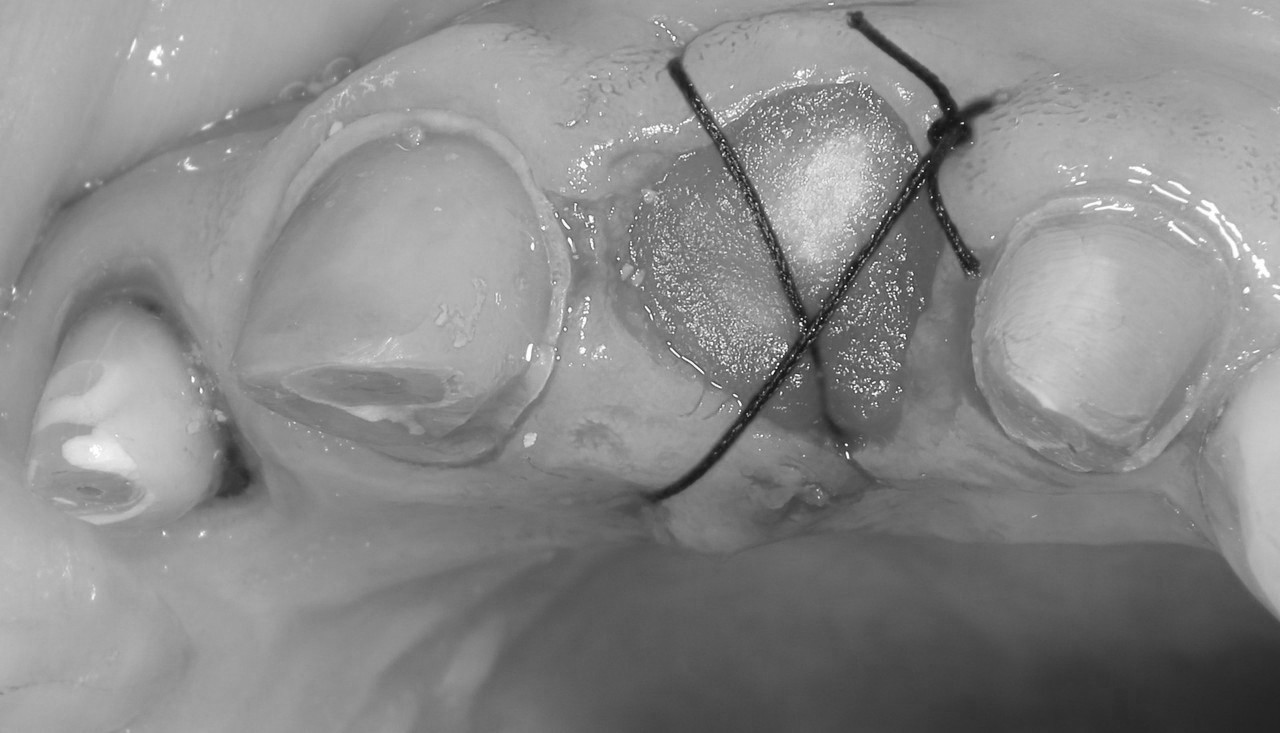 前歯（根の先に穴が開いていた）を抜歯したセラミッククラウンの症例