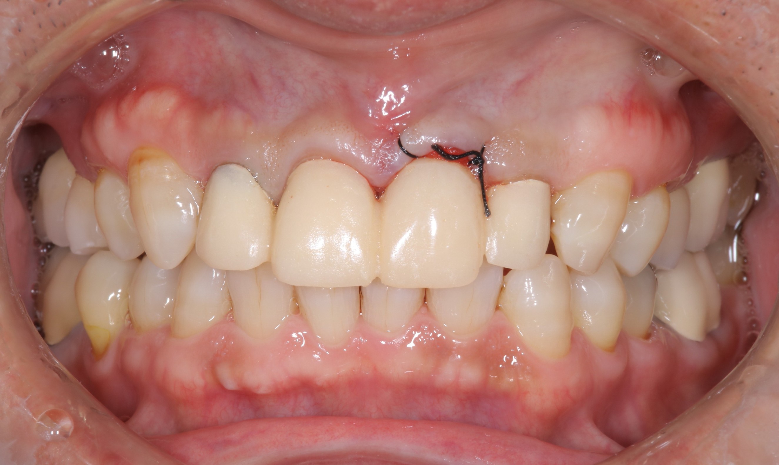 前歯（根の先に穴が開いていた）を抜歯したセラミッククラウンの症例