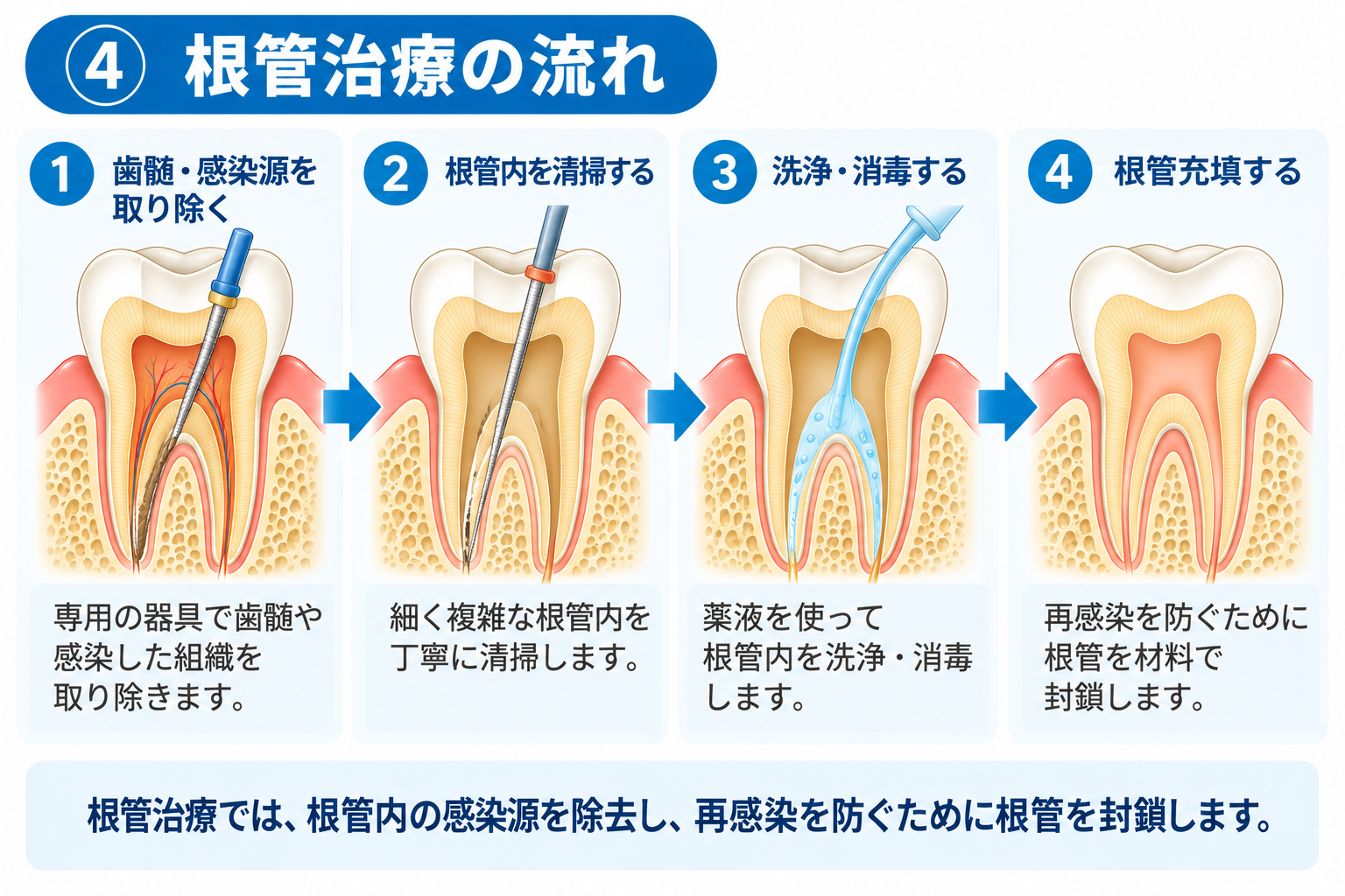 「根管治療」と「抜髄」は同じ?歯の神経を残すことの大切さ
