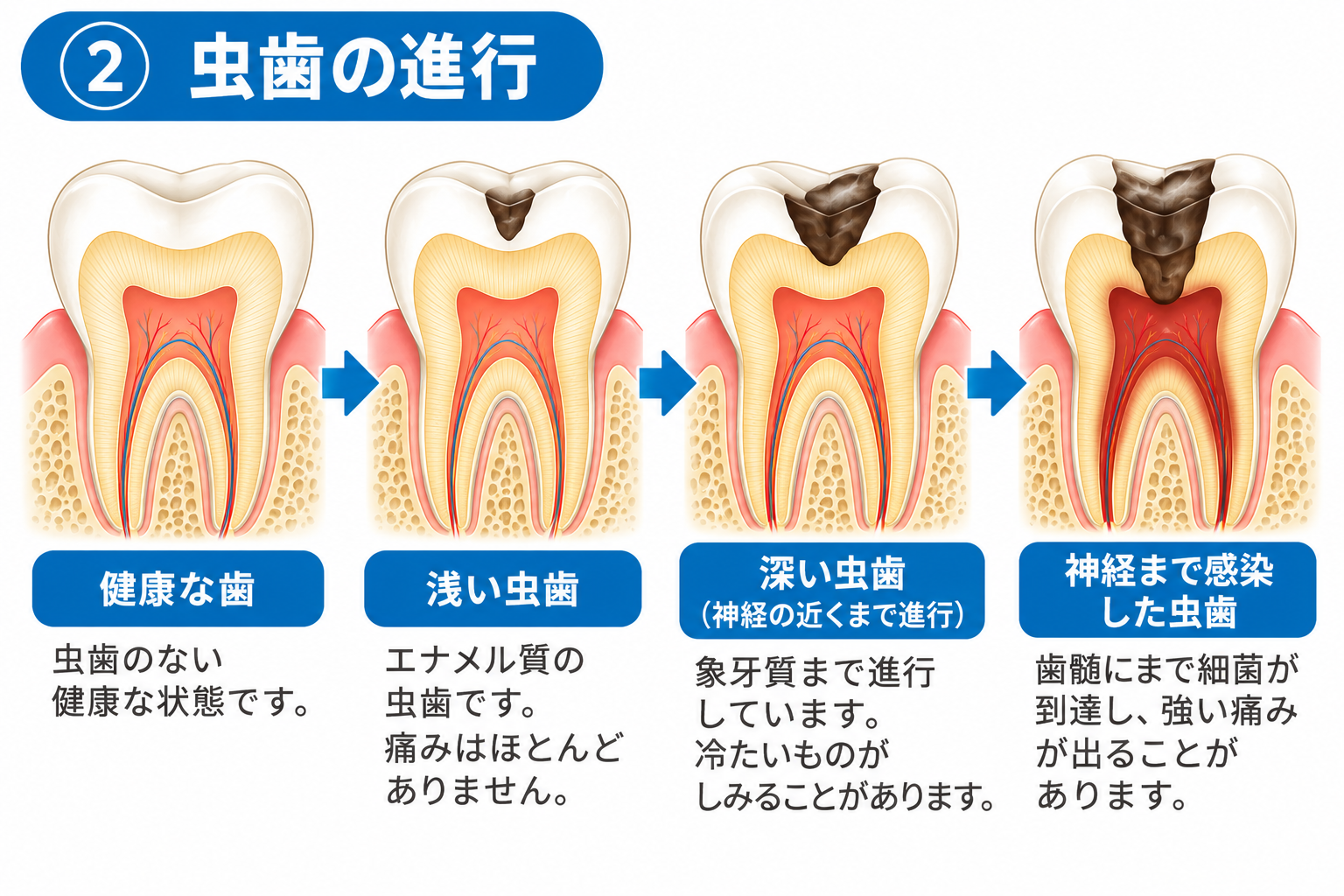 「根管治療」と「抜髄」は同じ?歯の神経を残すことの大切さ
