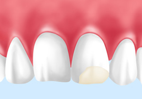 臼歯部のダイレクトボンディング