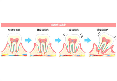 歯周病の進行症状について