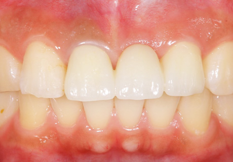 歯周外科治療（フラップ手術）の症例